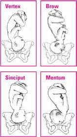 Image result for Brow Presentation