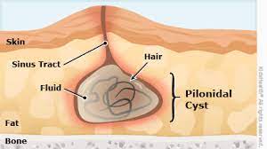 Check if you have an ingrown toenail. Pilonidal Cyst For Parents Nemours Kidshealth