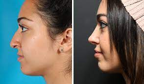 If this is your first surgery and you don't have any functional problems or have not had any trauma to the nose, then your surgery cost would be on the lower end. Rhinoplasty Toronto Nose Job Cost Ontario Dr Asaria