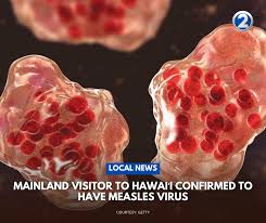 Image result for Measles
