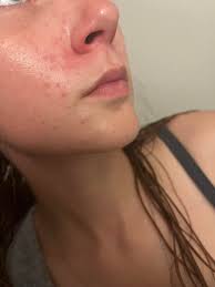 What could be causing irritated red bumps