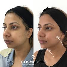 Unparalleled customer support to ensure you're supported every step of the way. Jaw Filler Before And After Experience True Jaw Dropping Results