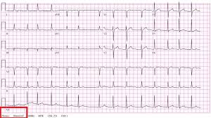 Maybe you would like to learn more about one of these? Kalibrasi Standar Ekg Sebelum Komunitas Pembelajar Ekg Facebook