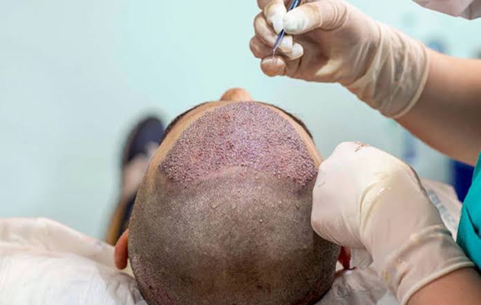 Hair Transplant Dubai | Hair Clinic Dubai