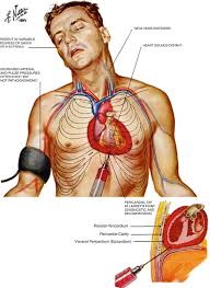 Image result for Pericardium