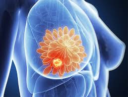 Jaundice, which is a yellowing of the skin and eyes swelling in the abdomen due to a buildup of fluid Symptoms And Diagnosis Of Metastatic Breast Cancer