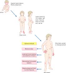 Vor allem kinder, aber auch erwachsene leiden unter den leitsymptomen wie trockene haut mit quälendem juckreiz und immer wiederkehrenden ekzemen. Atopisches Ekzem Wikiwand
