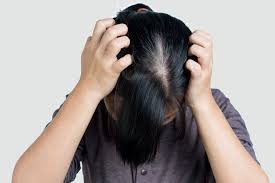 La pelade diffère de la calvitie qui, elle, cause une perte de cheveux et non de poils. Alopecie Femme Nicolas Klein