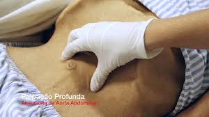 Temos um aneurisma da aorta abdominal quando essa artéria atinge um diâmetro 50% maior do que o esperado, sendo que o seu diâmetro máximo normal é de 2,0 cm. Aneurisma De Aorta Abdominal Inspecao E Palpacao Youtube