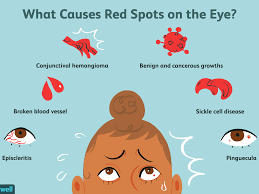 When you have a new notification, a red bubble will appear with the number of new notifications. Possible Causes Of A Red Spot On Your Eye
