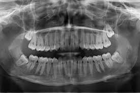 Zahnärzte und oralchirurgen entfernen die weisheitszähne, wenn sie platzmangel im kiefer, entzündungen und weisheitszahnentfernung: Weisheitszahnentfernung Dr Patricia Lowin