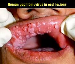 How did i get an oral hpv infection? Can You Get Hpv From Oral Sex