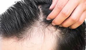 Daftar isi cara menghindari rambut yang semakin tipis 10 rekomendasi sampo terbaik untuk melebatkan rambut yang bisa kamu jadikan pilihan jika rambutmu dirasa sudah mulai lepek, kamu bisa menaburkan bedak bayi atau sampo kering. Rawat Rambut Gugur Cara Alami Untuk Elak Kepala Botak Sebelum Usia Maskulin