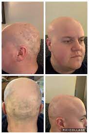 This damage inhibits or delays future hair growth. 2 Weeks Out From 2nd Laser Hair Removal Treatment 2 Days Since Last Shave Doing This Because I Don T Want To Shave Every Day And Have No Desire To Regrow Hair The