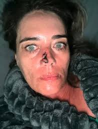 Image result for skin cancer on nose pimple