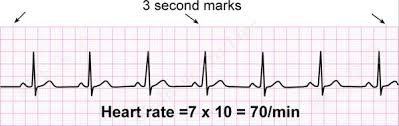 Ecg A Pictorial Primer