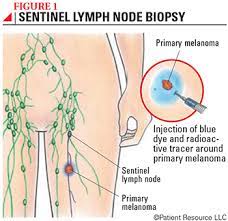 These are lymph nodes situated in the area between the chest wall and the lungs (called. Patient Resource Publishing Melanoma Lymph Node Mapping