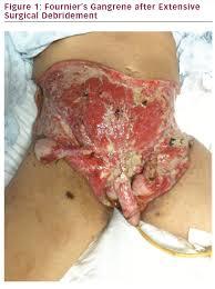 Check spelling or type a new query. Extensive Fournier S Gangrene In A Patient With Type 2 Diabetes Touchendocrinology