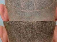 haartransplantation promis kosmono haartransplantation promis haare