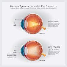 Early Onset Cataracts Signs Causes Treatment Of Premature Cataracts