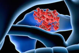 The second model of pancreatic cancer has 4 numbered stages, as follows: Pancreatic Cancer Symptoms Signs And Treatment Cancer Ut Southwestern Medical Center