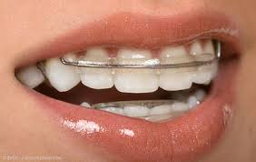 lose zahnspangen dr markus kohler