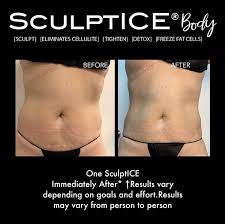 See our before & afters, watch treatment videos, schedule free consult with doctor. Sculptice Offers Body Contouring Training