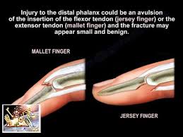 The injury usually occurs when the tip of the finger is suddenly extended as it is trying to flex. Mallet And Jersey Fingers Description Everything You Need To Know Dr Nabil Ebraheim Youtube