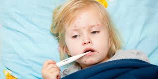 Mata berair dan sensitif kepada cahaya yang terang. Kenali Gejala Campak Dan Pencegahannya Halaman All Kompas Com