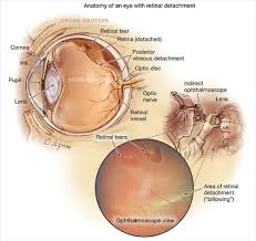 You should be fully aware about the effects before surgery. Retinal Detachment Retinal Detachment Eye Sight Improvement Opthalmic Technician