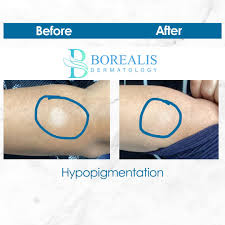 Image result for Postinflammatory Hypopigmentation