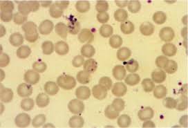 Unlike other forms of malaria, p. Chloroquine Resistant Plasmodium Falciparum Malaria In A Pregnant Woman Annals Of Saudi Medicine