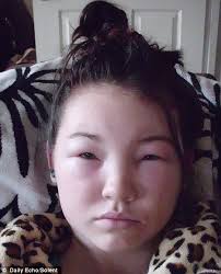 I Looked Like The Elephant Man Model Hopeful 14 Left With Head Twice Its Normal Size After Severe Reaction To Hair Dye Brown Hair Dye Dyed Hair Dye My Hair