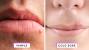 Early Stage Cold Sore Acne