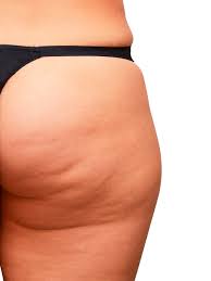 This term describes the fat tissue under your skin which usually is present your in thighs and butt. What Causes Sudden Cellulite The Cellulite Experts Lipotherapeia London