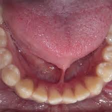 Image result for Ankyloglossia