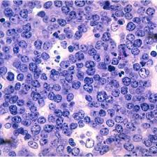 It can later involve other parts of the body including the lymph nodes and bone marrow. The Starry Sky Pattern Of Burkitt S Lymphoma The Tumour Cells Of B Download Scientific Diagram