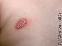 Image result for Eczema nummulare