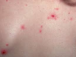 Image result for chickenpox