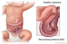 Image result for Necrotizing Enterocolitis