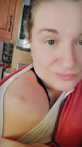 Francine Phillips, PA from our #Dermatology team shares her story of being  diagnosed with #melanoma at age 26