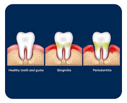 Image result for Gingivitis