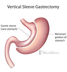 Micsorarea stomacului(gastric sleeve) este o operatie ce elimina aproximativ 75% din stomac. Ce Este Gastric Sleeve Gastric Sleeve Dr Mihai Ionescu