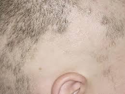 The good news is that it's very rare for infant hair loss to be associated with any medical problem. Alopecia Areata Babycenter