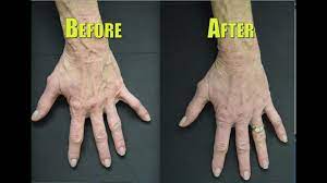 The best ways to make your veins pop out are to: Rejuvenate Your Hands By Fixing Bulging Veins