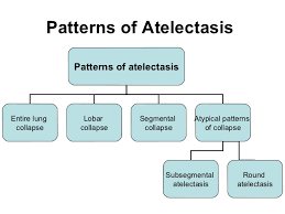 Atelectasis