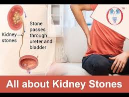 All About Kidney Stones Causes Symptoms Treatments Prevention Youtube Kidney Stones Kidney Prevention