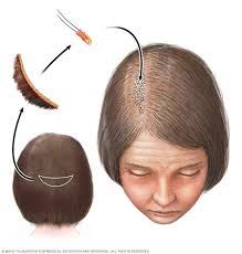 When it gets inside hair. Hair Loss Diagnosis And Treatment Mayo Clinic