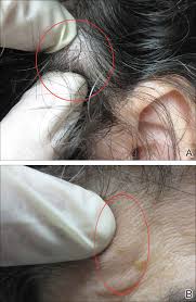 Skin cancer is one of the most common types of cancer. Metastatic Meningioma Of The Scalp Mdedge Dermatology