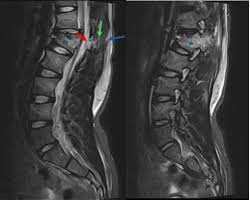 Image result for Chance Fracture